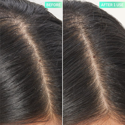 The Inkey List Salicylic Acid Exfoliating Scalp Treatment 150ml